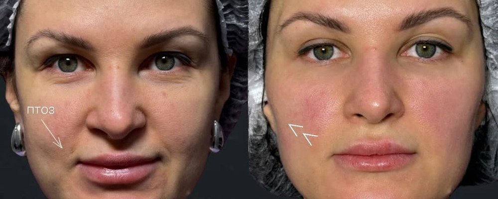 Контурная пластика лица